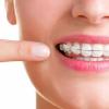 Niềng răng hô hàm trên giá bao nhiêu?