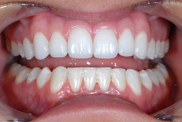 Kết quả hình ảnh cho răng sứ thẩm mỹ
