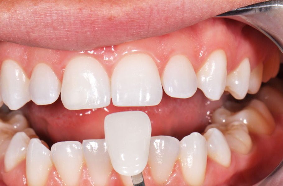 Kết quả hình ảnh cho răng sứ veneer