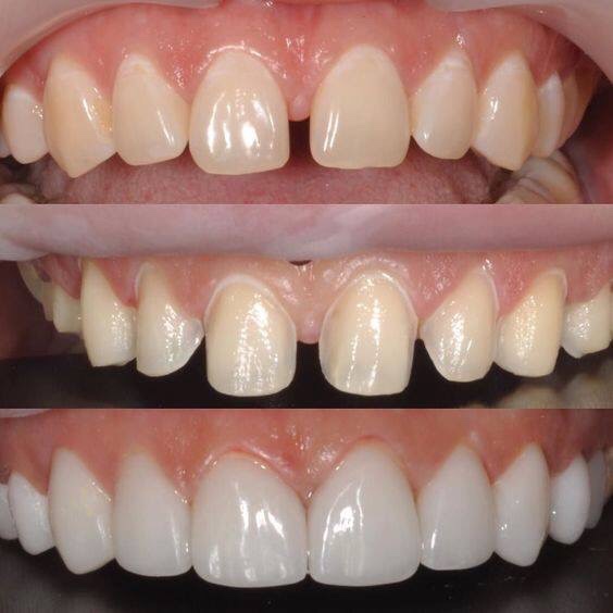 Kết quả hình ảnh cho răng sứ veneer