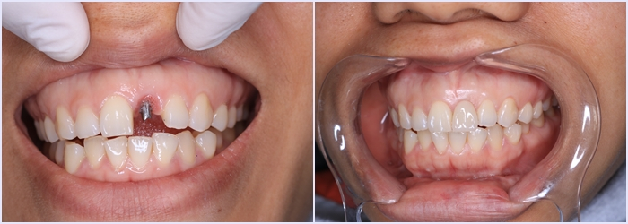 Tư vấn: Trồng răng implant là gì?