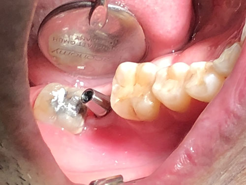 Trồng răng implant | Cấy ghép implant | Răng sứ | NHAKHOABSQUANG