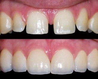 Trám răng thưa thẩm mỹ bằng phương pháp Laser - Composite