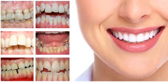 Thẩm mỹ răng sứ - Những lưu ý cần nhớ trước khi thực hiện