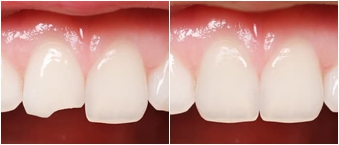 Những điều cần biết về phương pháp trám răng thẩm mỹ -