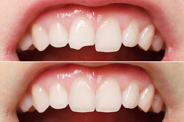 Trám răng cửa – Những lưu ý quan trọng khi phục hình cho răng