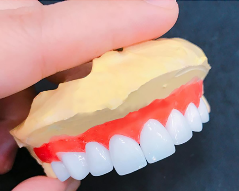 Kết quả hình ảnh cho răng sứ thẩm mỹ