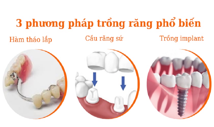 3 phương pháp răng sứ