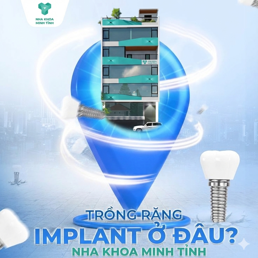 implant nha khoa