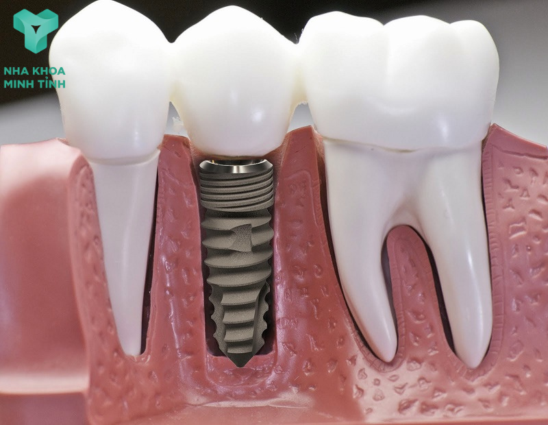 implant