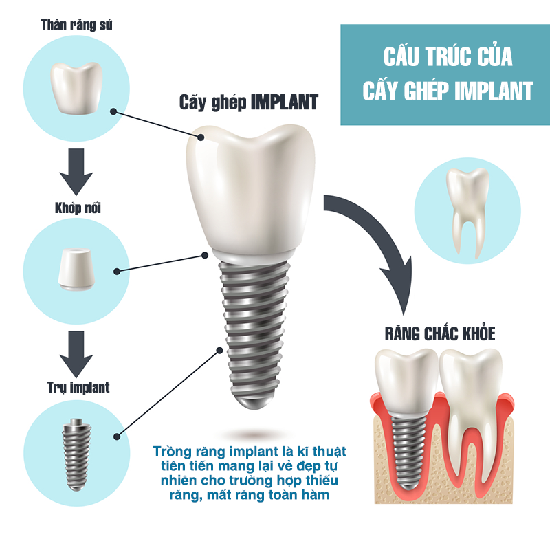 thanh-phan-cau-tao-implant